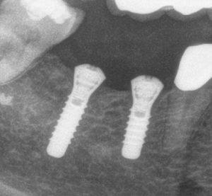 Implantate als künstliche Wurzel